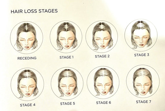 Stages of Hair Loss